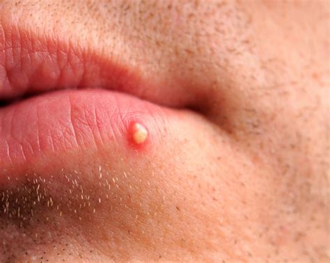 Pustules: What are they, Causes, Treatment Options, & Prevention Tips