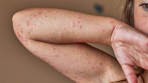 Allergic Reactions to Antibiotics: Symptoms and Rash Images - GoodRx