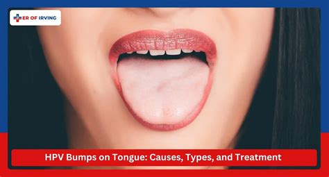 HPV bumps on tongue: Learn about its causes, types and treatment options