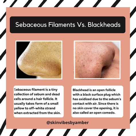 How to treat sebaceous filaments skin care face – Artofit