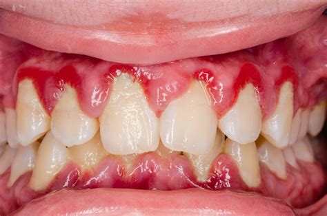 Gingivitis | The DADA2 Foundation