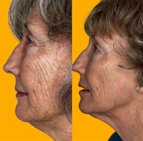 Sculptra | Fillers in Rochester NY — Tinytox Collab