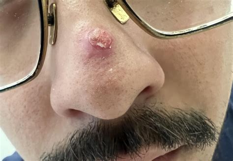 Wart on nose have tried everything & fluorourneil 5%, Salicylic acid 30 ...