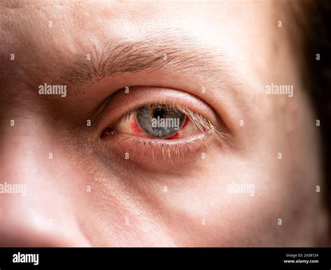 Blood in Eye. Bloodshot in Eyeball of Blood Pressure. Broken Vessels Stock Photo - Alamy