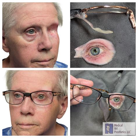 Orbital Eye Prosthesis Success Following Eye Loss Surgery