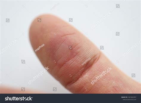 3,928 Calluses Fingers Images, Stock Photos & Vectors | Shutterstock