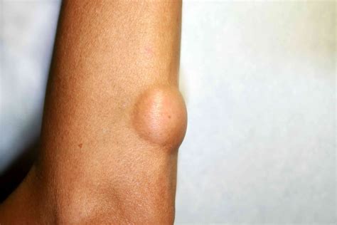 Hard Mass Under Skin