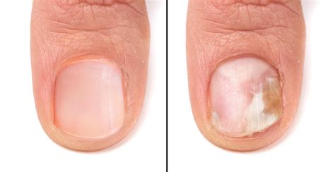 Fungal Nail Treatment Lotion at Ryan Cushman blog