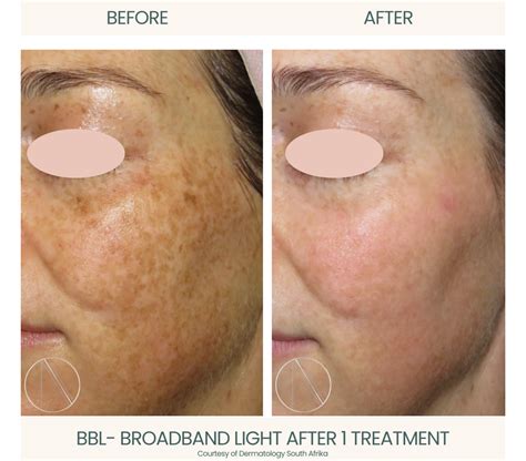 What Is BBL Face Treatment? Benefits, Process, and Safety Explained - Ayana Dermatology & Aesthetics