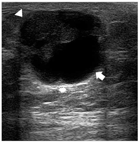 Radiological Features of Male Breast Neoplasms: How to Improve the Management of a Rare Disease