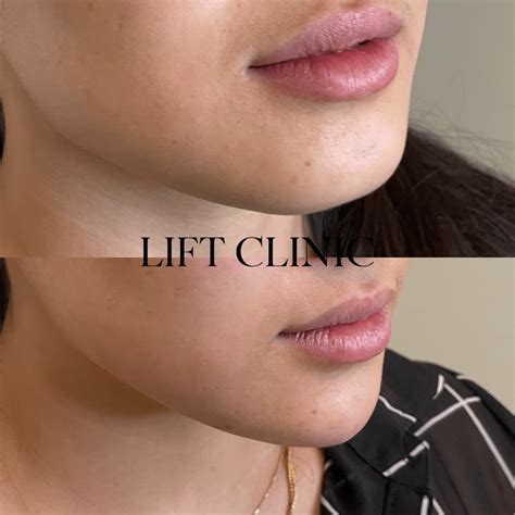 What Does 1ml of Lip Filler Look Like? 1ml Lip Fillers Before and After ...
