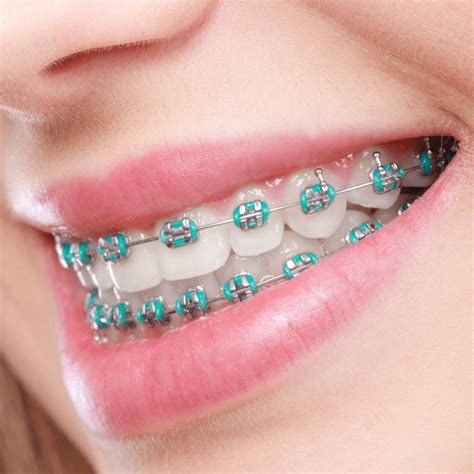 Choosing the Right Braces: Exploring the Different Types Available and ...