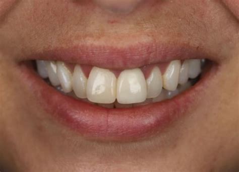 Gum Abscess Popped? Thinking of Popping It Yourself?