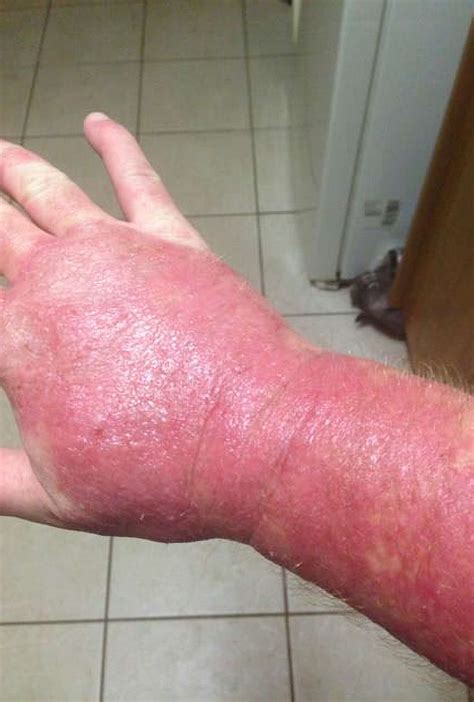 Allergy To Washing Liquid