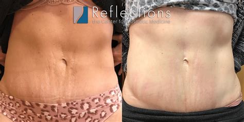 In-Office Solutions For Red And White Stretch Marks, 52% OFF