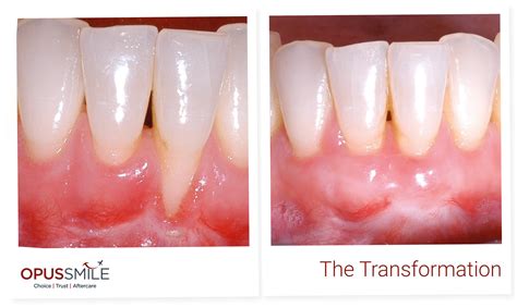 Gum Reconstruction Surgery