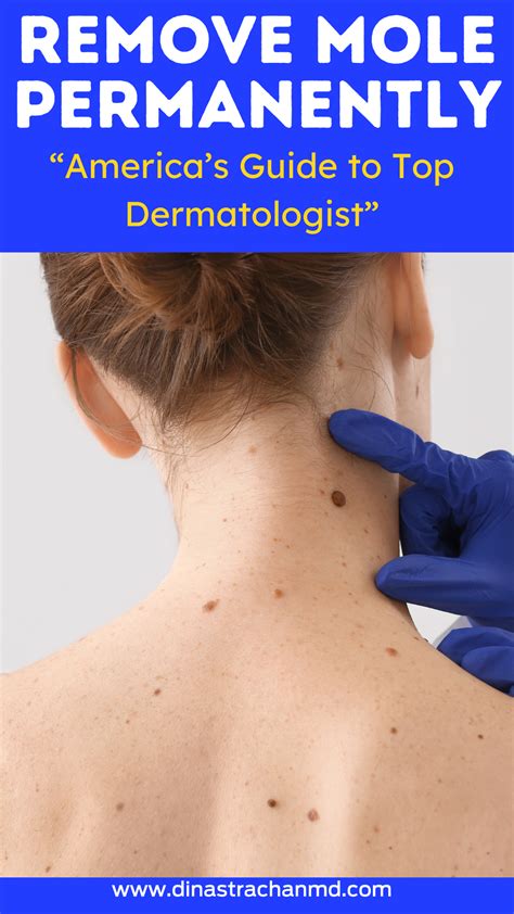Permanently Remove Moles with Expert Dermatologist Solutions | Mole removal, Skin moles, Dermatology