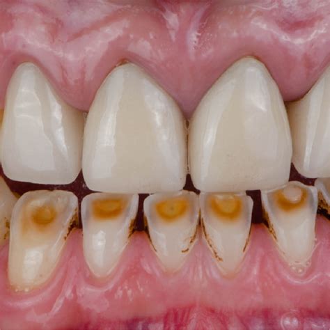 Attrition | Good Living Medical Centre