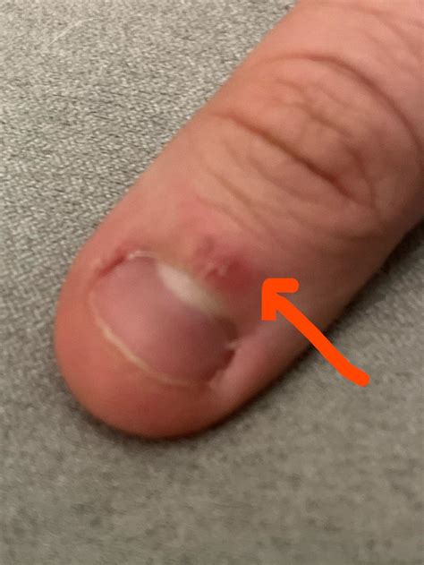 My finger skin peels like this all the time. Why does it happen, and ...