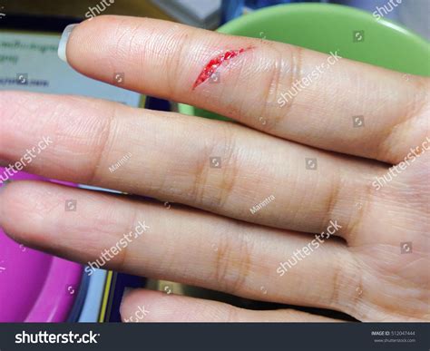 Finger Cut By Knife