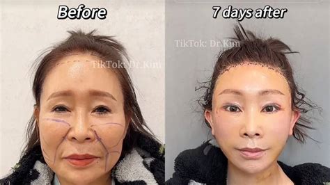 TikTok Plastic Surgeon Goes Viral for Uncanny Before-And-After Videos ...