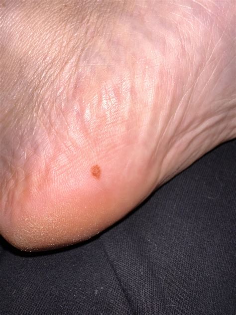 Mole sole of foot : r/Dermoscopy
