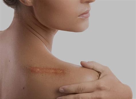 Non Cancerous Lesions Skin - Benign Growth on Skin | rtwskin