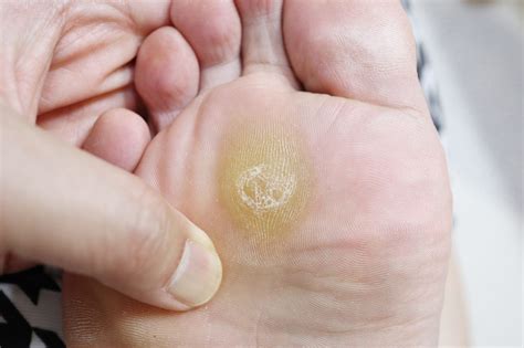What’s the Difference Between Foot Corns vs Foot Calluses? - Foot and ...