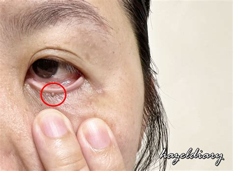 My Skin Tag Removal Experience Near the Eyelids at The Clifford Clinic ...
