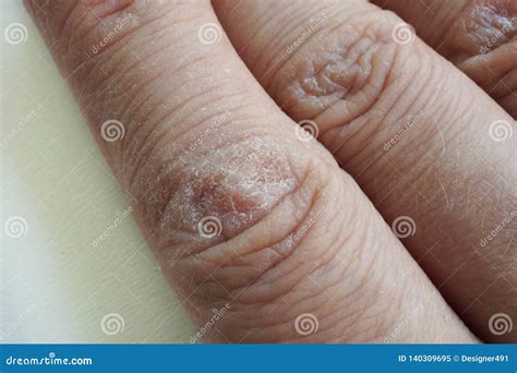 Close Up of Hands with Dry Cracked Skin Stock Image - Image of human ...