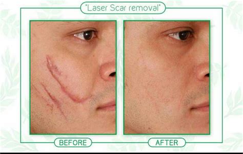 Scar Treatment Australia at Pearl Brandon blog
