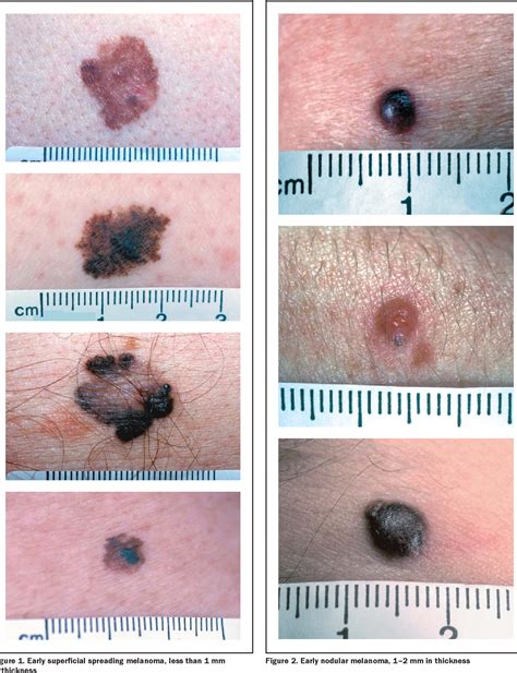 Nodular Malignant Melanoma Skin Lesions