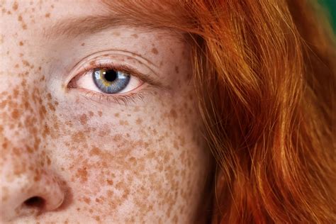 How to Get Rid of Freckles? | Natalie's Skin Solutions | Med Spa