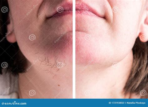 Hairs on Chin. Hair Removal on Face. Stock Photo - Image of caucasian ...
