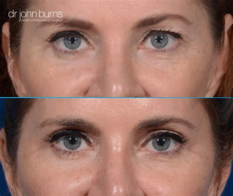 Eyelid Lift-Blepharoplasty-Dallas Plastic Surgeon-Dr. John Burns – Dr John Burns