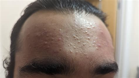 Acne On Forehead