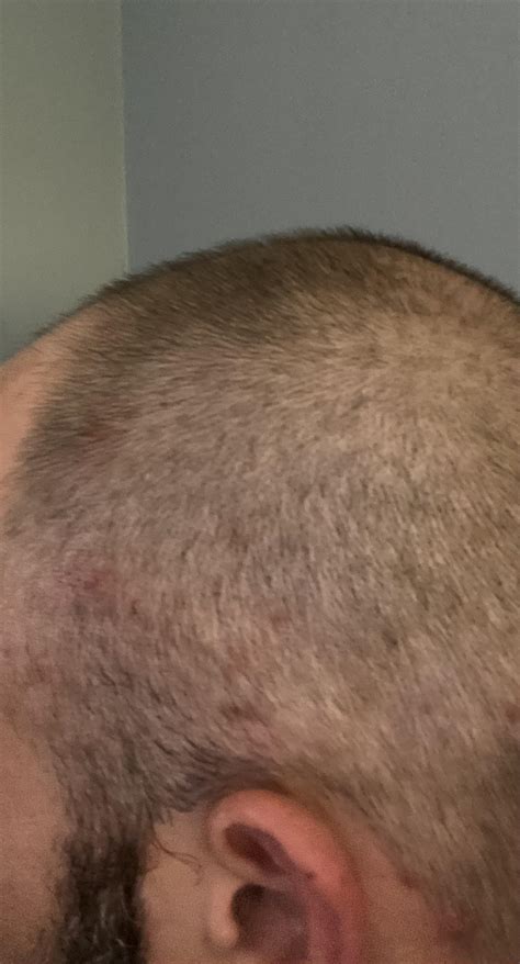 Skincare on my scalp. [acne] : r/SkincareAddiction