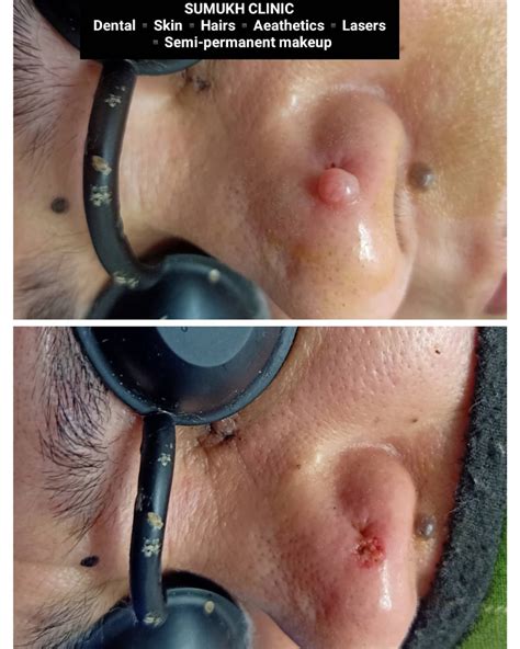 Infected Nose Piercing- Symptoms, Treatment, Causes - Psycho Tats