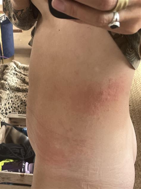 xolair side effects? : r/urticaria