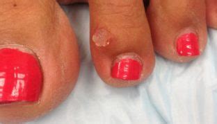 Derm Dx: Translucent papule filled with jelly-like fluid - Clinical Advisor
