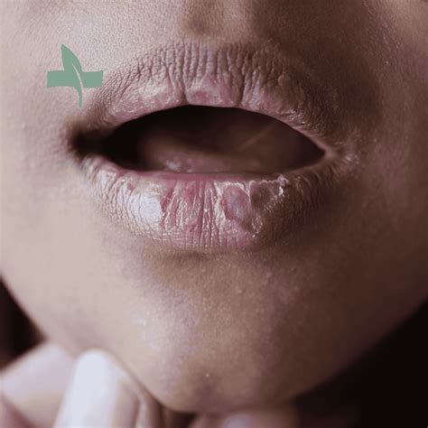 Chapped Lips: Causes, Symptoms and Treatments — SageMED