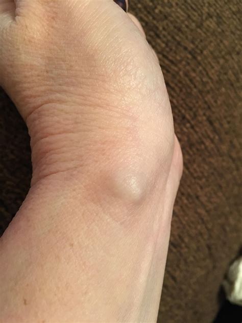 To the poster who asked if anyone else has carpal tunnel. See the knot ...