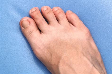 Ingrown toenail - Sergio Mazzei