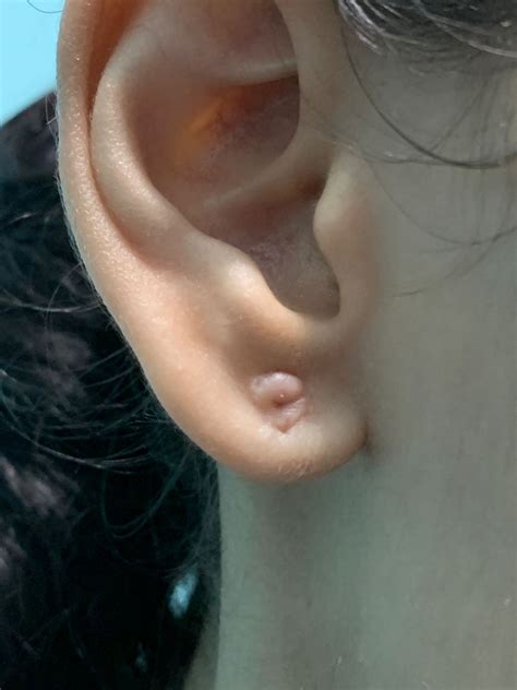 Infected Cyst of Ear Lobule After Piercing