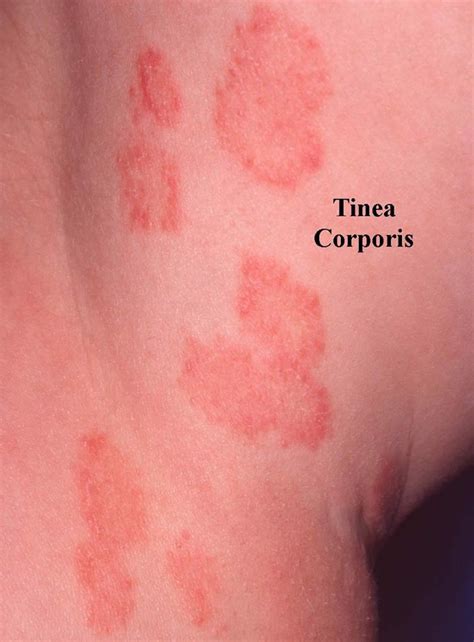 Ringworm, tinea, causes, signs, symptoms, diagnosis & treatment