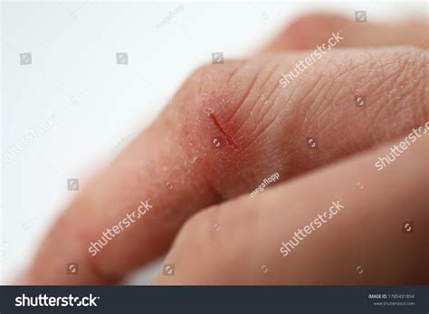 1,761 Skin Fissure Images, Stock Photos, 3D objects, & Vectors ...