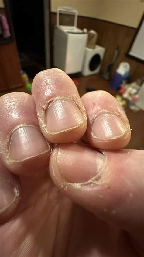 Positive ANA AC-7 and AC-2, 1:320 titer, Dense fine speckled and few Nuclear dots. : r/scleroderma