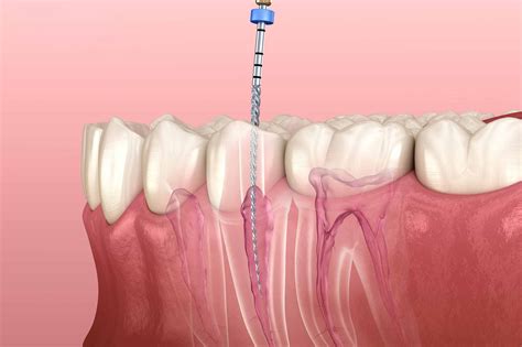 Orthodontic Treatment For Rct Teeth at Winnie Norris blog