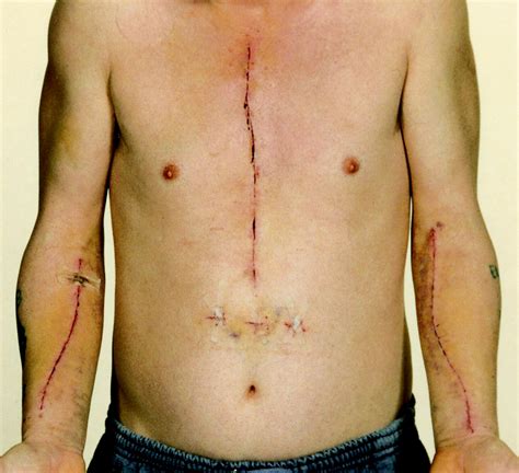 Scar Treatment After Open Heart Surgery at Lidia Bechtol blog