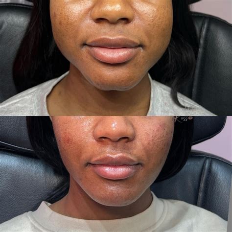 Jaw Slimming with Botox: Benefits and What to Expect